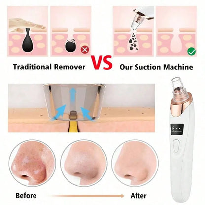 VacuGlow Blackhead Remover